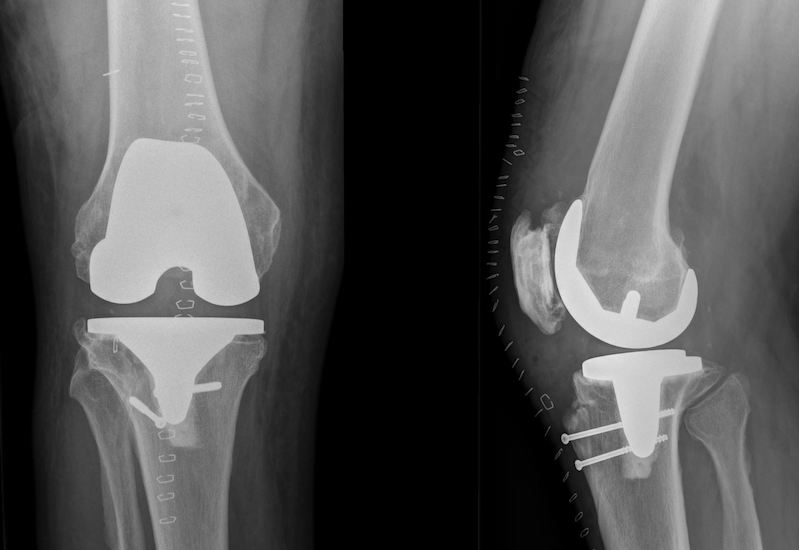 DePuy J&J Sigma RP Total Knee Prosthesis (Implant 190722)
